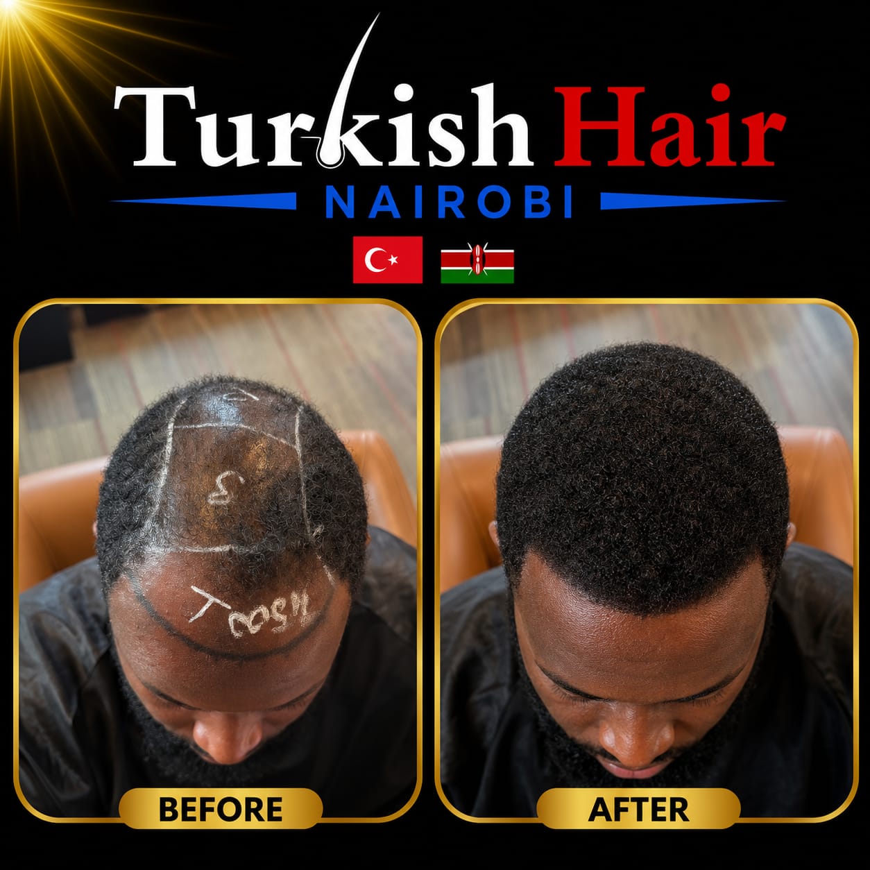 Turkish Hair Nairobi Case 1